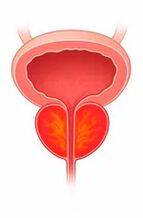 Inflammation de la prostate